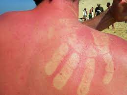 Was Tun Bei Sonnenbrand Oma Weiss Alles