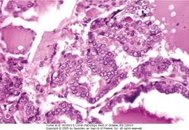 The nuclei of the carcinoma cells have a distinctive empty appearance due to finely dispersed chromatin. Pathology Block Iv Pics Flashcards Chegg Com
