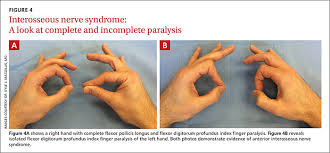 Hoffmans sign and hyperreflexia in a patient with shoulder and arm pain. Hand Compression Neuropathy An Assessment Guide Mdedge Family Medicine