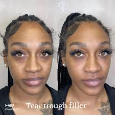 38 top Tear Trough Filler ideas in 2025