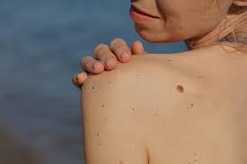 Jul 18, 2021 · how does melanoma make you feel? Skin Cancer And Moles Am I At Risk Uchealth Today
