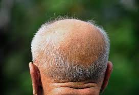 Why Is Hair Loss More Common In Men Premature Grey Hair Why Hair Loss Premature Gray Hair Treatment