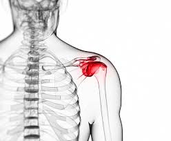 Les muscles sollicités finissent par rester contractés. Comment Detendre Une Epaule Gelee Physiotherapie Sportive Montreal