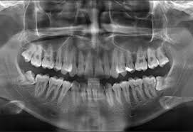 Dental X Ray Opg In 2020 Dental Facial Bones X Ray