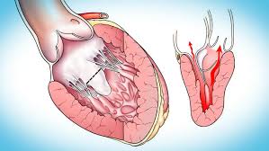 Image result for Left Ventricular Outflow Obstruction
