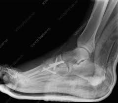 Image result for Foot XRay