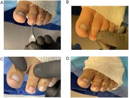 Image result for Glomus tumor