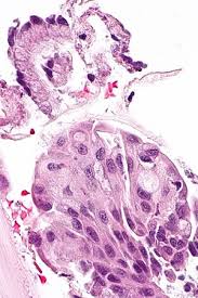 For the period of treatment it is necessary to keep. Squamous Metaplasia Of The Uterine Cervix Libre Pathology