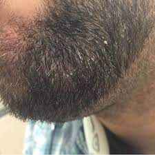 10 Reasons Why The Skin Under Your Beard Hurts: Stop Beard Itch & Pain -  Beard And Company