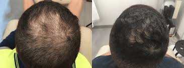 Our team has many years of experience in dealing with male and. Advanced Hair Loss Treatment That Works Hairgen Hq Perth