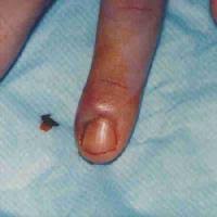 Image result for phlegmon of hand)