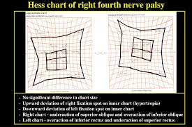 Ppt Ocular Motor Nerve Palsies Powerpoint Presentation