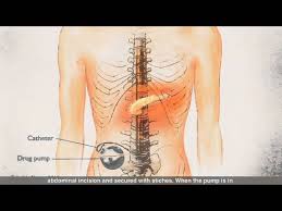 Image result for Intrathecal Pump