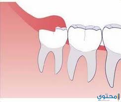 موضوع تعبير عن الأسنان موقع محتوى
