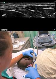 Image result for Ear Nerve Block