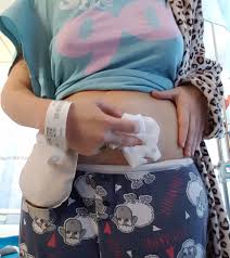 The first few times you change your colostomy bag on your own it will almost certainly feel challenging. How I Change My Urostomy Bag Securicare