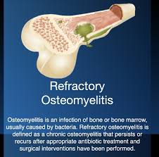 Image result for Osteomyelitis
