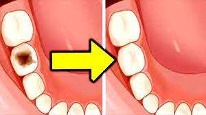 How To Heal Tooth Decay And Reverse Cavities Using This Easy Remedy Youtube Reverse Cavities Tooth Decay Remedies Tooth Decay