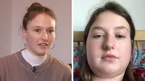 Image result for Mumps