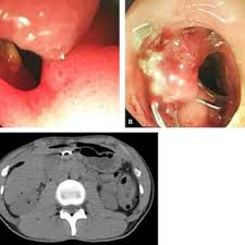 Stomach of tablets, pain and ulcer. A A Perforated Peptic Ulcer Was Found In The Greater Curvature Of The Download Scientific Diagram