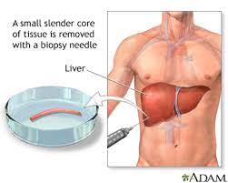The removed tissue is examined for cancer or any other cell abnormalities. Liver Biopsy Healthing Ca