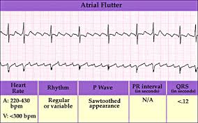 Atrial Flutter Picture Gif 500 312 Pixels Atrial Flutter Ekg Interpretation Flutter
