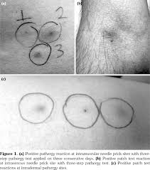 Image result for Pathergy