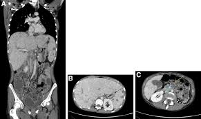 Persistent Fever And Abdominal Pain In A Young Woman With Budd Chiari Syndrome Gastroenterology