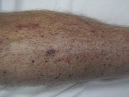 However, malignancy should always be considered a possibility when establishing leg ulcer diagnosis (ellison and mccollum, 1998). Skin Cancer And Rashes Cancerous And Precancerous Lesions