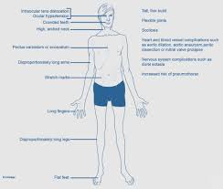 Associated Conditions Pectus Clinic