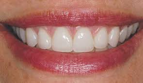 Porcelain Veneers Your Smile Better Than Ever