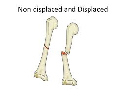 If open fracture choose from following types of open fractures a. Fracture Coding Cm And Pcs