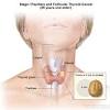 Though thyroid nodules are common, about 5% of these are cancerous. 1