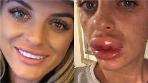 Learn more about what the whipple procedure does and what to expect if you or someone you love is due to have this lymph. 2018 S Worst Cosmetic Surgery Mishaps Fox News