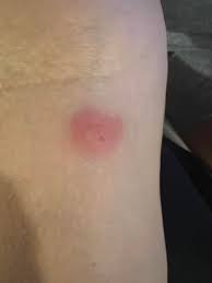 Image result for spinne biss haut reaktion