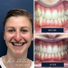 Tuesday Transformation 💫 WOW, Look at these incredible Invisalign results  by Dr Anne Green!!! This lady started her Invisalign journey in April 2023  and completed in April 2024 ready to shine for