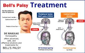 Bell's palsy is a condition in which one side of the face suffers nerve damage, causing severe this immobilization causes a droop on the affected side of the face. Bells Palsy Homeopathic Treatment Idiopathic Facial Paralysis