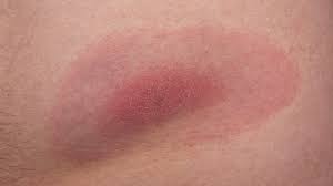 Lb je způsobena bakterií komplexu borrelia burgdorferi sensu lato. Lymska Borelioza Popis Diagnozy Priciny A Lecba