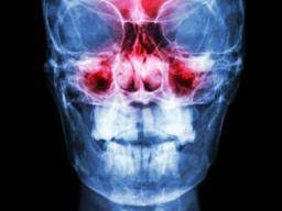 Nasal polyp operation is not generally advised by doctors. Sinus Surgery Types Recovery Risks And Alternatives