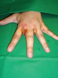 Image result for phlegmon of hand)