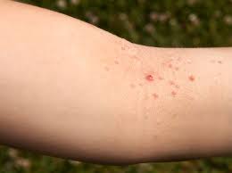 Dellwarzen Ursache Symptome Heilung Wunderweib Heilung Hautausschlag Ursache