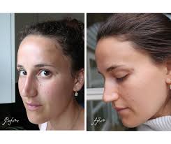 How I Got Rid Of My Hyperpigmentation In One Month (Exact Skincare Steps)