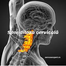 Tratamentele medicamentoase ajuta doar in combaterea simptomelor neplacute. Spondiloza CervicalÄ Ce Tratament ExistÄ