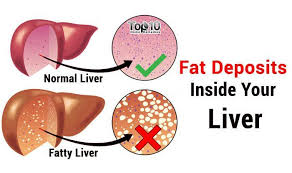 Home Remedies For Fatty Liver Disease Fatty Liver Disease Fatty Liver Liver Detox