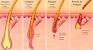 Ingrown Hair Cyst Diagram