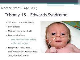 Edward syndrome is also known as trisomy 18. 15 Trisomy 18 Aka Edwards Syndrome Ideas Edwards Syndrome Trisomy 18 Heart Defect