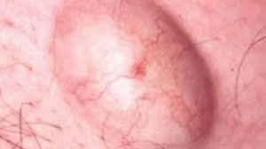 These ingrown hairs can sometimes get infected. Ingrown Hair Cysts Deep Causes Symptoms Get Rid Removal Pubic Hair Cyst Large Pictures Under Skin Infected Treatment