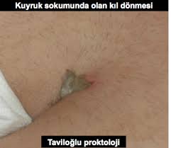 Kil Donmesi Pilonidal Sinus Hakkinda Bilinmesi Gerekenler Probiyotix