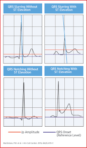 Image result for Early Repolarization