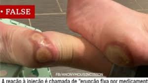 Devo me preocupar com essas reações alérgicas à vacinas da covid? Covid 19 Como Meu Pe Virou Meme Mentiroso Contra Vacinas